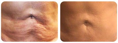 Skin Tightening (Stomach)